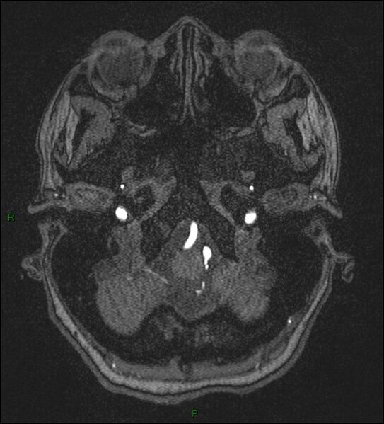 File:Cerebral fat embolism (Radiopaedia 35022-36525 Axial TOF 22).jpg