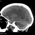 Cerebral hemorrhagic contusion with subdural and subarachnoid hemorrhage (Radiopaedia 10680-11146 C 14).jpg