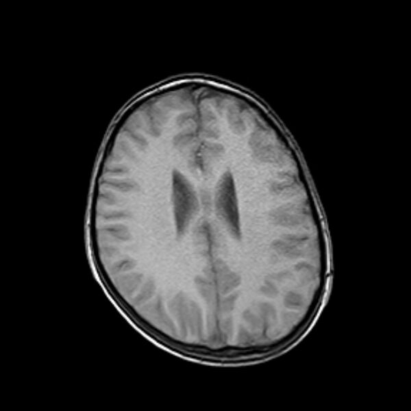 File:Cerebral tuberculoma (Radiopaedia 41152-43932 Axial T1 15).jpg