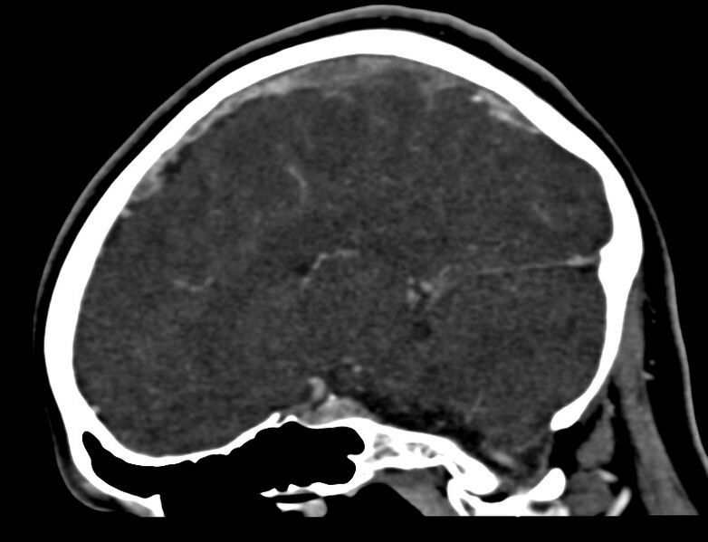 File:Cerebral venous sinus thrombosis (Radiopaedia 59224-66646 Sagittal C+ delayed 18).jpg