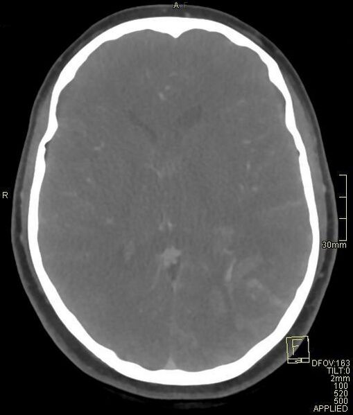 File:Cerebral venous sinus thrombosis (Radiopaedia 91329-108965 Axial venogram 44).jpg