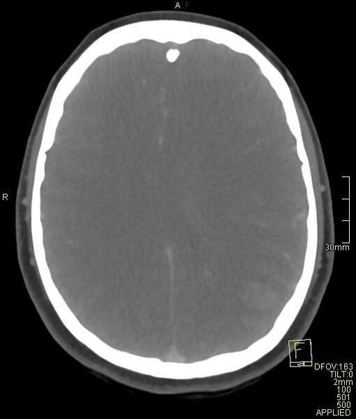 File:Cerebral venous sinus thrombosis (Radiopaedia 91329-108965 Axial venogram 52).jpg