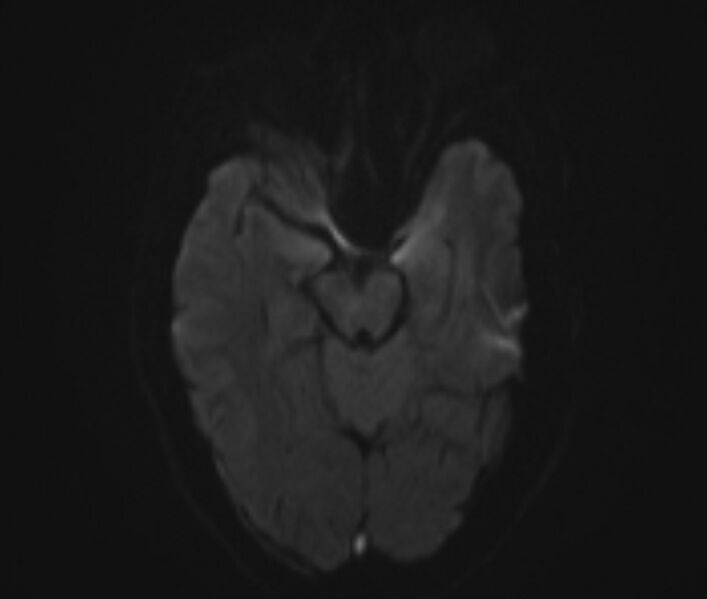 File:Cerebral venous thrombosis (Radiopaedia 71207-81504 Axial DWI 7).jpg