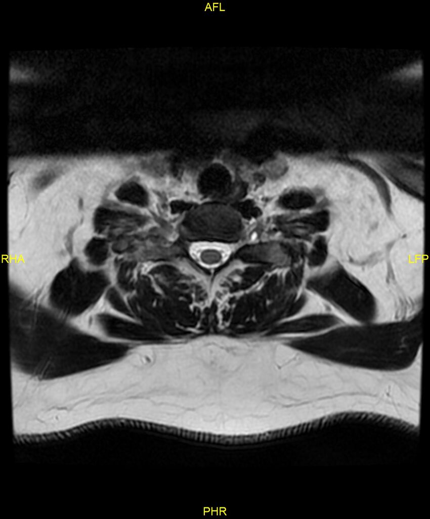Cervical disc protrusion (Radiopaedia 87147-103415 Axial T2 68).jpg
