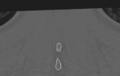Cervical disc replacement (Radiopaedia 37383-39205 Coronal bone window 59).png