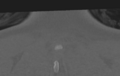 Cervical disc replacement (Radiopaedia 37383-39205 Coronal bone window 64).png