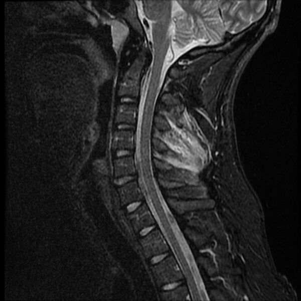 File:Cervical facet fracture and anterior discoligamentous injury (Radiopaedia 32139-33084 Sagittal STIR 8).jpg