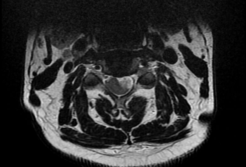 File:Cervical schwannoma (Radiopaedia 72399-82934 Axial T2 6).jpg