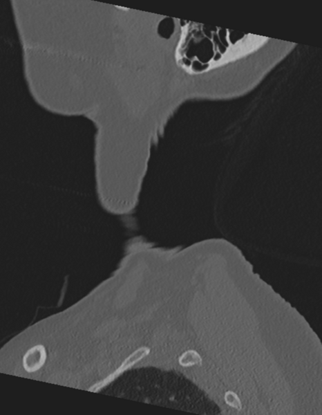File:Cervical spine ACDF loosening (Radiopaedia 48998-54071 Sagittal bone window 5).png