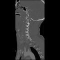 Cervical spine fractures with vertebral artery dissection (Radiopaedia 32135-33078 Sagittal bone window 28).jpg