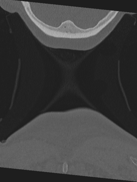 File:Cervical spondylolysis (Radiopaedia 49616-54811 Coronal bone window 75).png