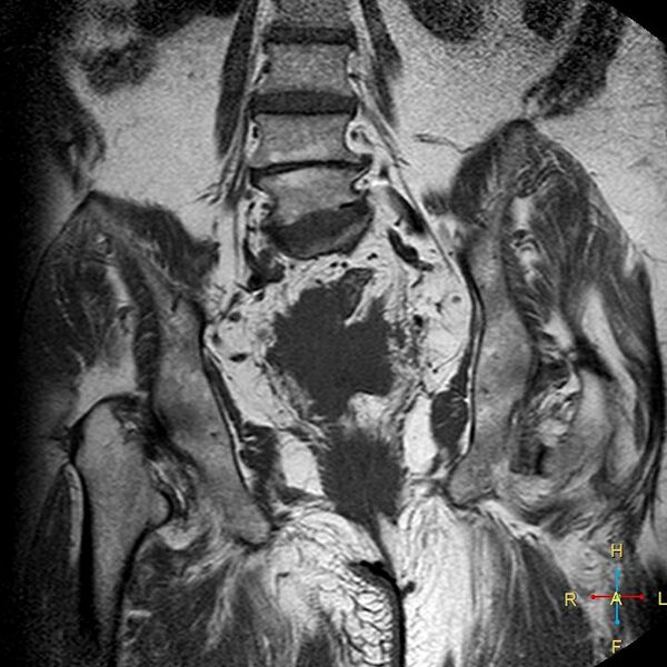 File:Cervical stump squamous cell carcinoma (Radiopaedia 48049-52858 Coronal T1 12).jpg