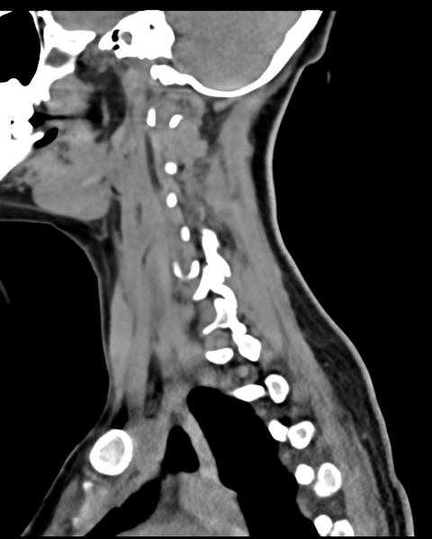 File:Cervical tuberculous spondylitis (Radiopaedia 39149-41365 D 20).png