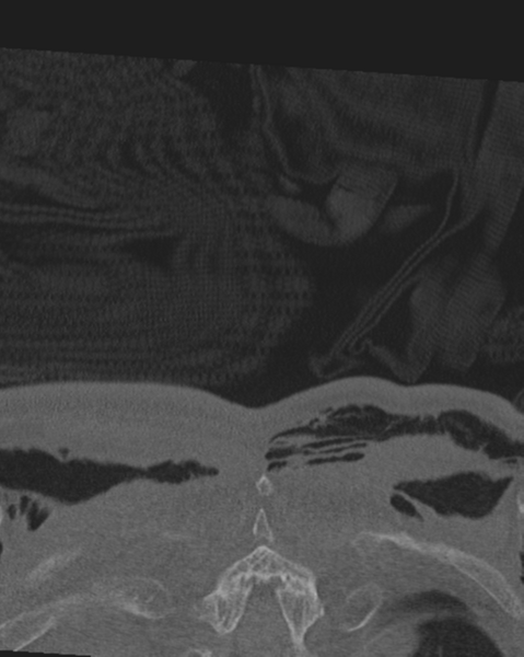 File:Chalk stick fracture (Radiopaedia 57948-64928 Coronal bone window 80).png