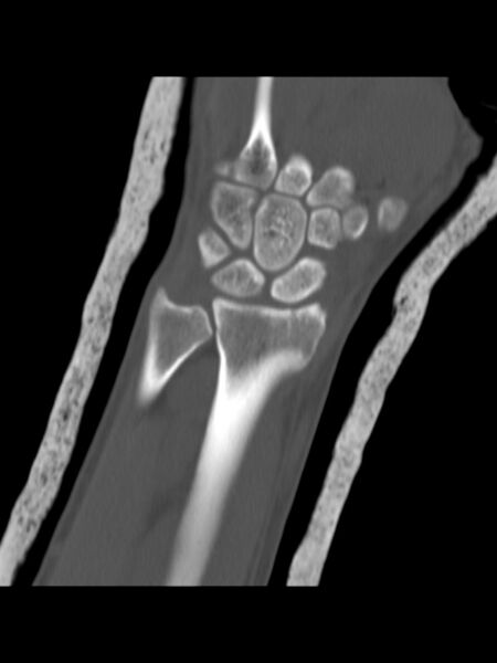 File:Chauffeur's (Hutchinson) fracture (Radiopaedia 58043-65079 Coronal bone window 7).jpg