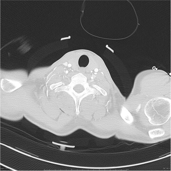 File:Chest and abdomen multi-trauma (Radiopaedia 26294-26425 lung window 7).jpg