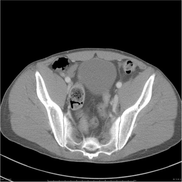 File:Chest and abdomen multi-trauma (Radiopaedia 26294-26426 A 71).jpg