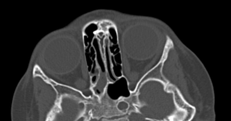 File:Choanal atresia (Radiopaedia 51295-56972 Axial bone window 44).jpg