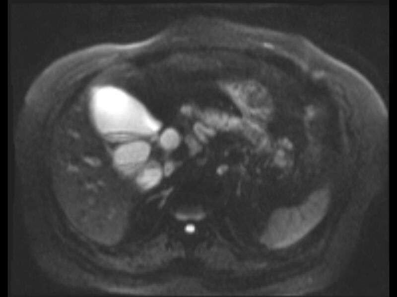 File:Choledocholithiasis causing intrahepatic biliary duct dilation (Radiopaedia 39908-42369 Axial T2 SPAIR 42).jpg