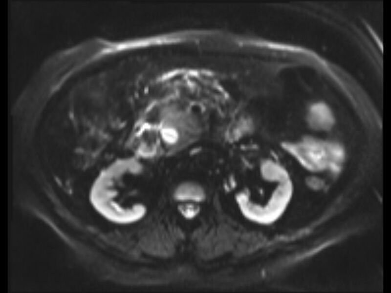 File:Choledocholithiasis causing intrahepatic biliary duct dilation (Radiopaedia 39908-42369 Axial T2 SPAIR 9).jpg