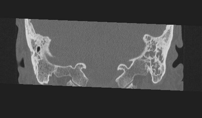 File:Cholesteatoma (Radiopaedia 10742-11203 Coronal bone window 27).jpg