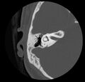 Cholesteatoma (Radiopaedia 20296-20217 bone window 30).jpg