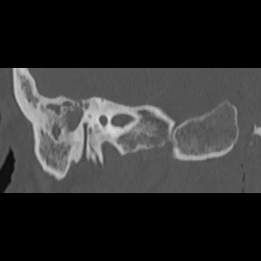 Cholesteatoma (Radiopaedia 68176-77673 Coronal bone window 47).jpg