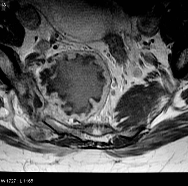 File:Chondrosarcoma - sacrum (Radiopaedia 6173-7627 Axial T1 C+ 5).jpg