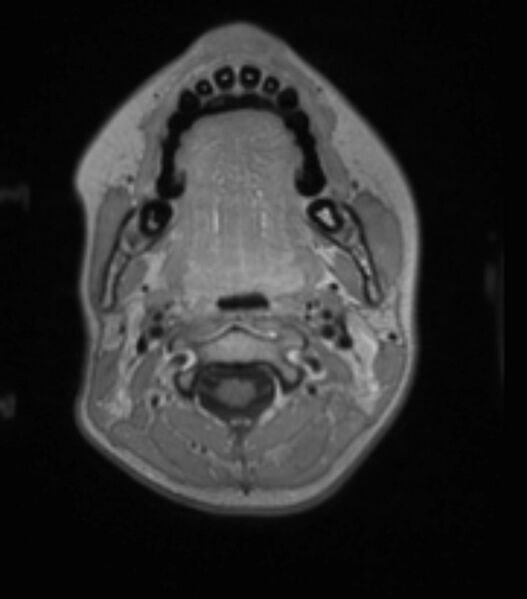 File:Choroid plexus carcinoma (Radiopaedia 91013-108553 Axial T1 C+ 43).jpg