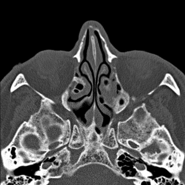 File:Chronic maxillary sinusitis (Radiopaedia 27879-28116 Axial bone window 26).jpg