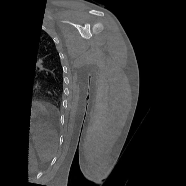 File:Chronic osteomyelitis (Radiopaedia 67597-76998 Coronal bone window 16).jpg