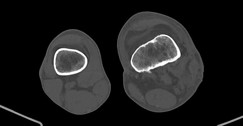 Chronic osteomyelitis (with sequestrum) (Radiopaedia 74813-85822 Axial non-contrast 170).jpg