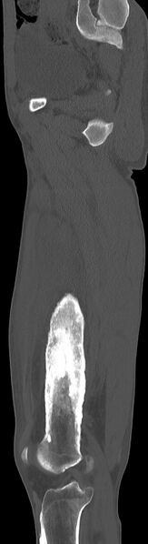 File:Chronic osteomyelitis (with sequestrum) (Radiopaedia 74813-85822 C 71).jpg