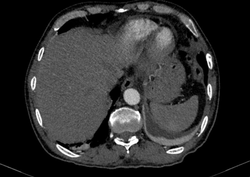 File:Chronic pulmonary embolism with bubbly consolidation (Radiopaedia 91248-108850 C+ arterial phase 128).jpg