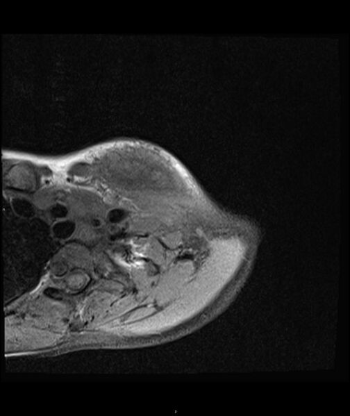 File:Chronic reactive multifocal osteomyelitis (CRMO) - clavicle (Radiopaedia 56406-63071 Axial T1 fat sat 6).jpg