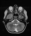 Chronic reactive multifocal osteomyelitis (CRMO) - mandible (Radiopaedia 56405-63069 Axial T2 23).jpg