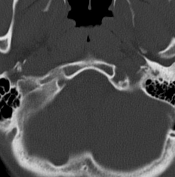 File:Cleft of the posterior arch of C1 mimicking fracture (Radiopaedia 40201-42721 Axial bone window 22).jpg