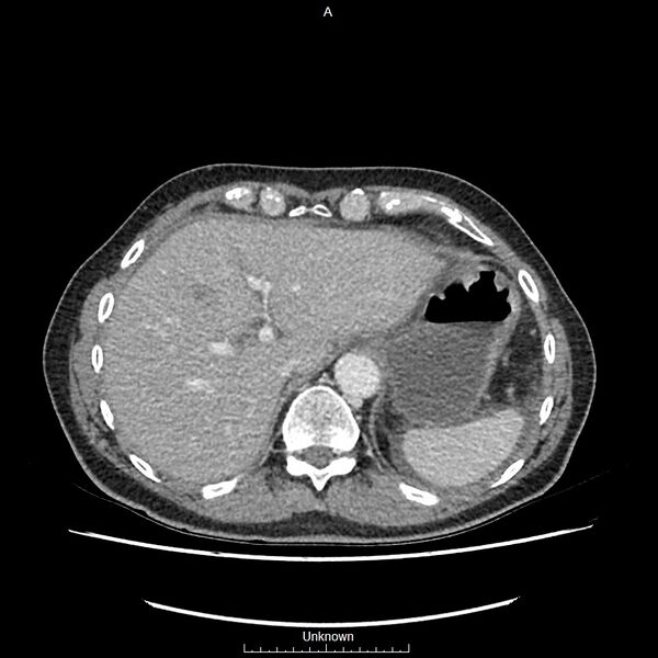 File:Closed loop bowel obstruction and ischemia (Radiopaedia 86959-103180 A 6).jpg