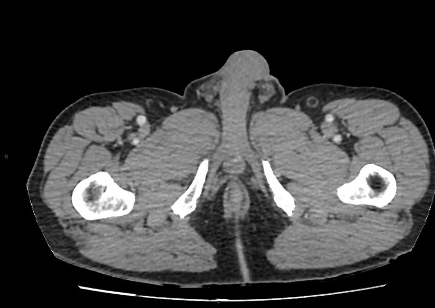 Closed loop small bowel obstruction with ischemia (Radiopaedia 84180-99456 A 134).jpg
