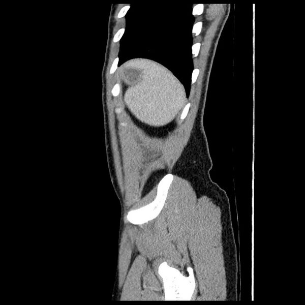 File:Co-existing acute appendicitis and epiploic appendagitis (Radiopaedia 61789-69911 B 85).jpg