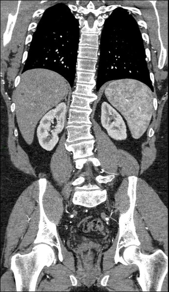 File:Coarctation of the aorta (Radiopaedia 74632-88521 B 170).jpg
