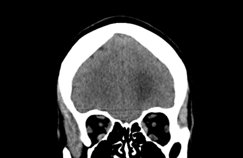Colloid cyst (Radiopaedia 53180-59146 Coronal non-contrast 15).jpg