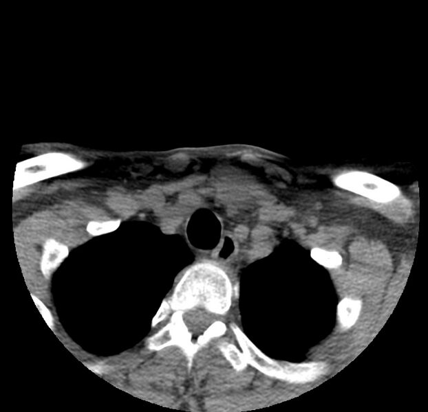 File:Colloid cyst of thyroid (Radiopaedia 22897-22923 Axial non-contrast 50).jpg