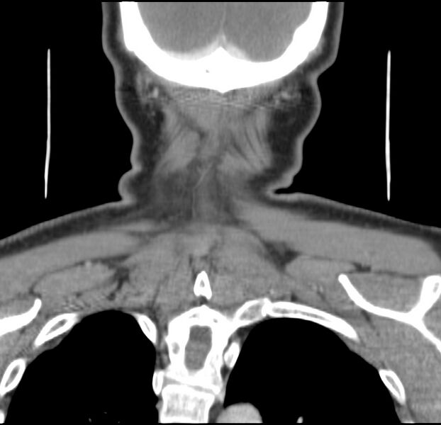 File:Colloid cyst of thyroid (Radiopaedia 22897-22923 Coronal C+ delayed 56).jpg