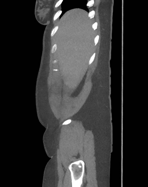 File:Colonic pseudo-obstruction (Radiopaedia 79752-92980 C 13).png
