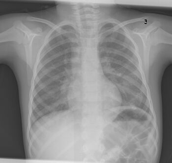 X-ray ribs: multiple enchondroma