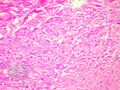 Figure 2 (DermNet NZ pathology-e-angiomyofibroblastoma-figure-2).jpg
