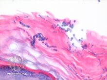 Histology: Malassezia spores (S) and filaments in outer skin layer