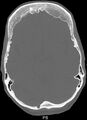 Hyperostosis frontalis interna (Radiopaedia 35921).jpg
