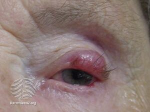 Merkel cell carcinoma (DermNet NZ lesions-eyelid-merkel-1).jpg